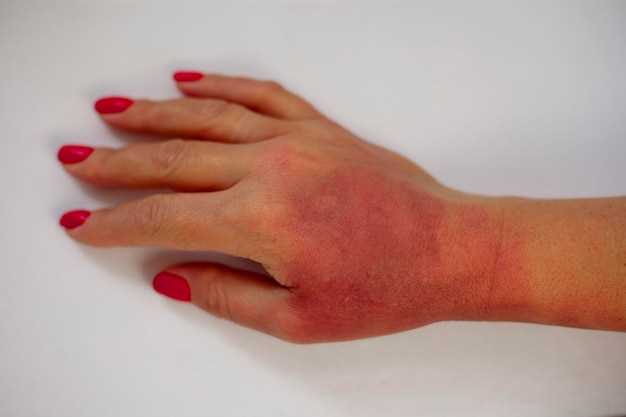 Возможные заболевания, вызывающие красные пятна на коже руки